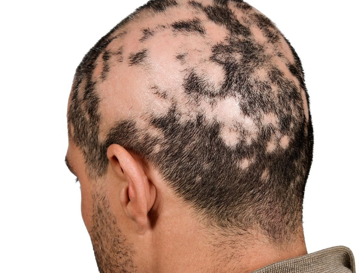 Alopecia Treatment